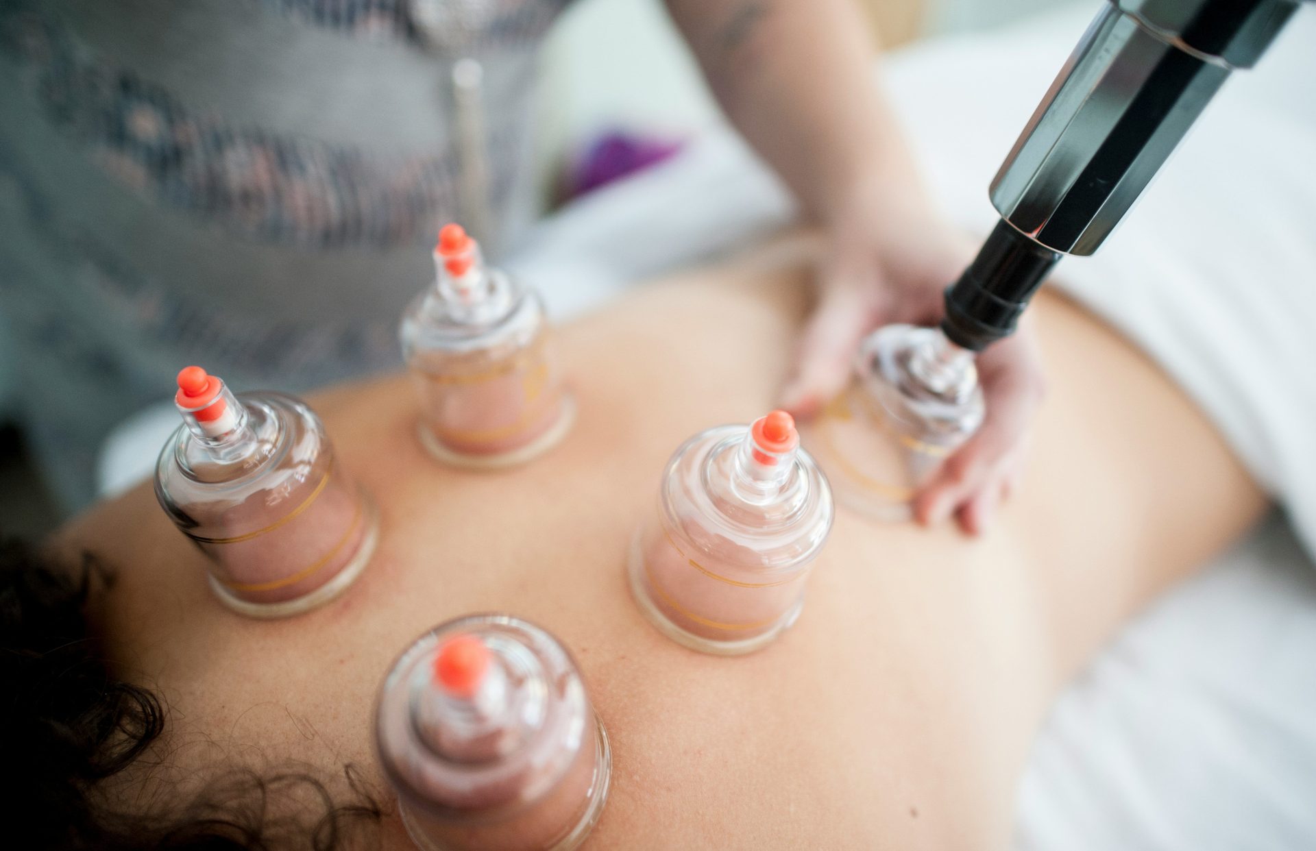 A person receiving cupping therapy with glass cups on their back